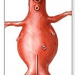 aneurisma_aorta_21