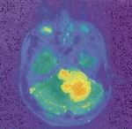 glioma_thumb