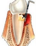 parodontite