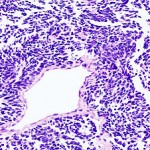 300px-Lung_small_cell_carcinoma_(2)_by_core_needle_biopsy