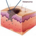 7de0melanoma-300x298