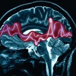 Epilessia (1)