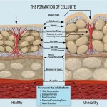 Formation_of_Cellulite