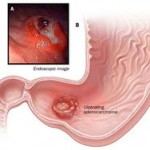 cancro-allo-stomaco-nemico-di-10-000-vittime-l-anno-ancora-sottovalutato