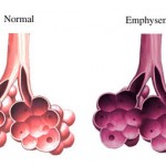 enfisema (2)