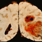 glioblastoma
