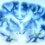 sclerosi_multipla (2)