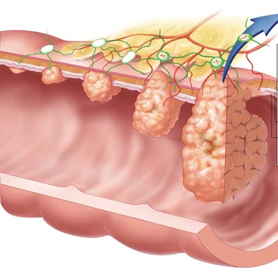 Intestino con il colon