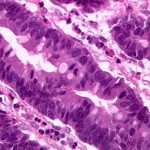 tumore-stomaco-e1289143832548