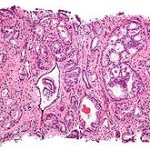 250px-Prostate_cancer_with_Gleason_pattern_4_low_mag