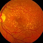 270px-Intermediate_age_related_macular_degeneration