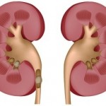 Healthy kidney and kidney with stones, eps8