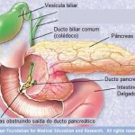 pancreatitisandgallstones