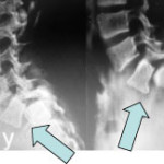 spondilolistesi_02