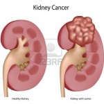 9549383-cancro-del-rene-eps8