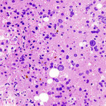 250px-Hepatocellular_carcinoma_histopathology_(1)