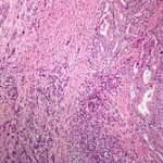Anaplastic_thyroid_carcinoma_low_mag