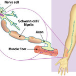 Charcot-Marie-Tooth-Disease1