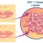 cause-herpes-labiale