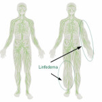 linfedema
