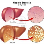 14225592-steatosi-epatica