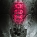 16418761-lesioni-o-doloroso-di-back-raggi-x-immagine-lesioni-del-midollo-spinale