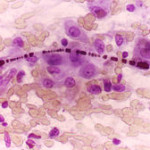220px-Carcinoma_asbestos_body_lung