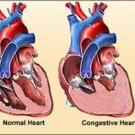 insufficienza_cardiaca