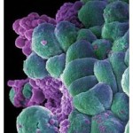 tumore_alla_prostata_diagnosi