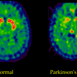 Parkinson_01