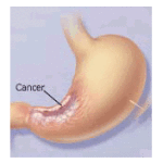 cancro-stomaco