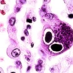 citomegalovirus (1)