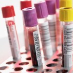 news_821_iperlipidemia_postprandiale