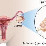 ovaio_policistico_schema