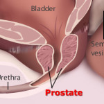 prostata-news