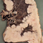MESOT
