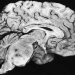 Pontine_astrocytoma