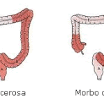 morbo-di-crohn
