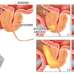 stages-of-prostate-cancer