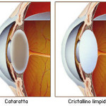 cataratta
