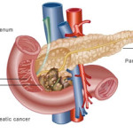 tumore-al-pancreas