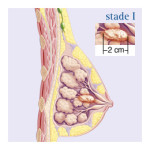 536_popup_cancer-sein-stade-1-3555210
