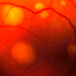 Multifocal-Morbus-Best---Photo