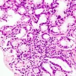 Sindrome-di-Sjogren