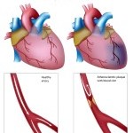9693632-attacco-di-cuore-eps8