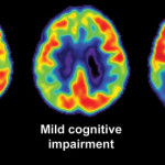 alzheimer-comparato
