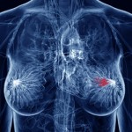 breast_cancer