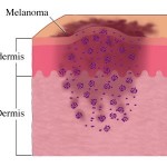 foto_melanoma (1)