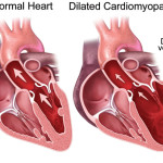 inform-cardiomiopatia