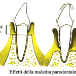 malattia-parodontale (1)